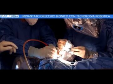 Il Primo Orecchio Bionico Con Tecnologia Robotica Nell’ospedale Di Padre Pio